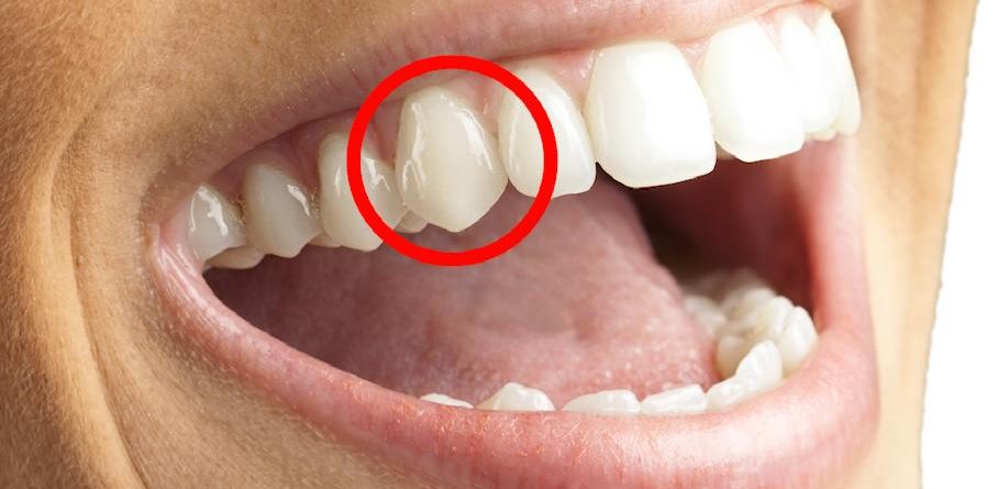 O dente canino é o dente da assertividade de alma e está ligado a ativação das ações em prol do autopreenchimento. A energia do canino está relacionada com nosso aspecto dual onde o ser homem ou mulher supõe um equilíbrio sutil e alquímico entre nosso interior masculino e feminino, vividos no plano dito virtuoso. Está ligado à noção de ESCOLHA, já que são os dentes do movimento, pois é de cada escolha que depende a direção que seguimos na vida. Ligado a impulsão da força produtiva e realizadora.