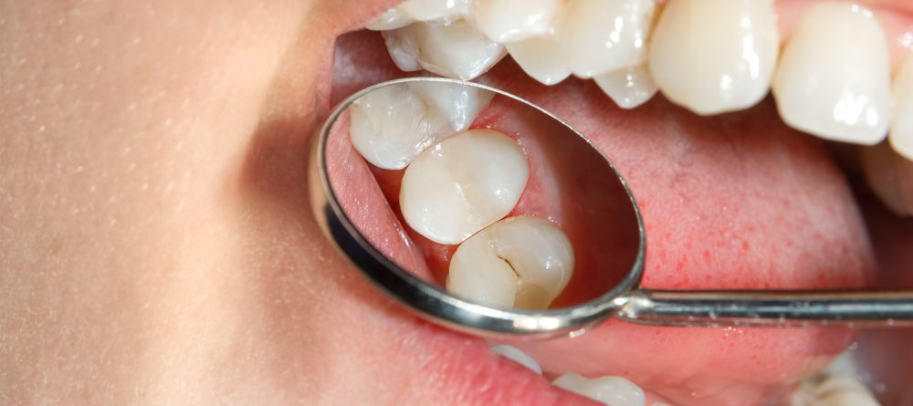 As cáries não são uma reação diante da necessidade de adaptar-se no mundo material, senão uma consequência do sofrimento experimentado em uma relação humana. Os dentes nomeiam de maneira precisa aquilo que provoca sofrimento ao nosso coração.