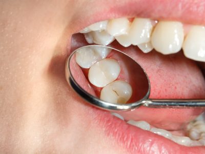 As cáries não são uma reação diante da necessidade de adaptar-se no mundo material, senão uma consequência do sofrimento experimentado em uma relação humana. Os dentes nomeiam de maneira precisa aquilo que provoca sofrimento ao nosso coração.