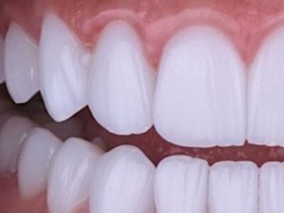 Os dentes refletem nossa identidade e através deles podemos fazer varias leituras que nos abrem consciência dos programas mentais que ditam nossas escolhas.