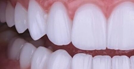 Os dentes refletem nossa identidade e através deles podemos fazer varias leituras que nos abrem consciência dos programas mentais que ditam nossas escolhas.